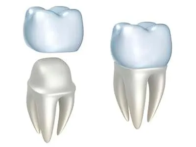 How A Crown Helps Following A Root Canal